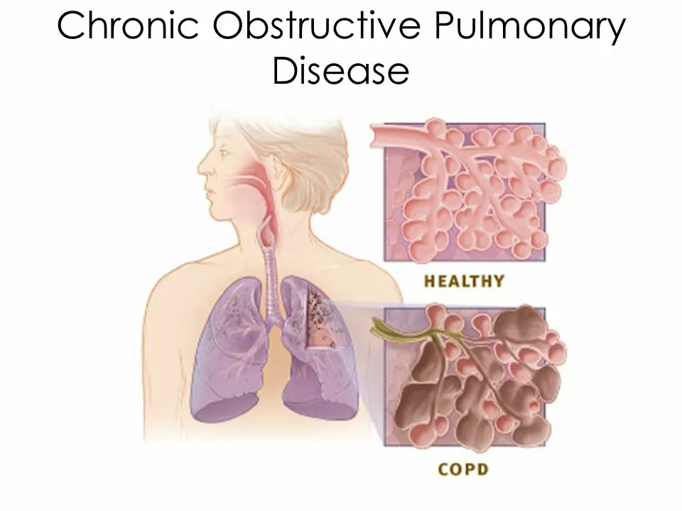 The Link Between Obstructive Pulmonary Disease and Asthma